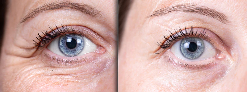 eyevage-before-after01