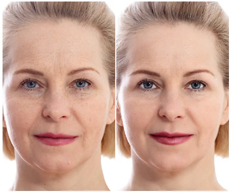 Infusoderm-before-after